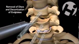 CERVICAL SURGERY C5C6C7 [upl. by Froemming]