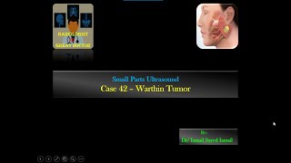 Ultrasound Case 42  Warthin Tumor [upl. by Alliuqa]