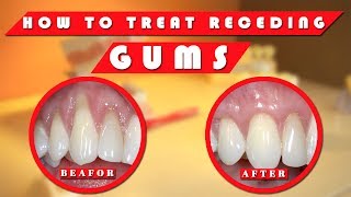 Receding gums How to stop receding gums at home naturally [upl. by Petes303]