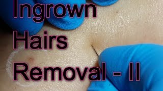 New Session of Ingrown Hairs Removal  II [upl. by Ardnued]