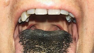 Black Hairy Tongue Symptoms and Causes  Diagnosis  Treatment  Prevention [upl. by Revolc]