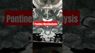 Pontine Myelinolysis shorts ytshorts mri [upl. by Candis]