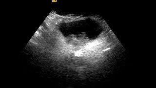 Urinary Bladder Mass  Differential Diagnosis [upl. by Airetak895]