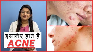 Acne Reason on Face  Acne Treatment [upl. by Hochman]