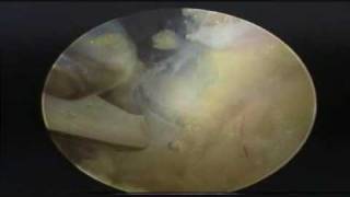 Arthroscopic Suprascapular Nerve Release [upl. by Shaia995]