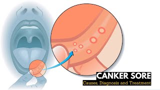 What is CANKER SORES Causes Signs and Symptoms Diagnosis and Treatment [upl. by Orgalim]