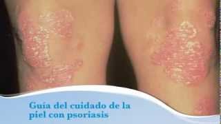 Guia del cuidado de la piel con psoriasis [upl. by Amato]