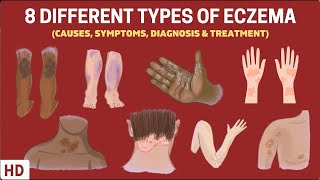 Eczema Exposed 8 Types You Need to Know [upl. by Biddick]