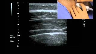 Transverse Abdominis Plane Block ultrasound guided [upl. by Aihsined]