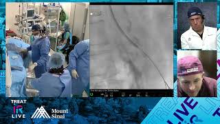 Transradial Stenting of Mesenteric Artery Occlusion for Chronic Mesenteric Ischemia [upl. by Willey]