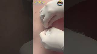 Squirting Cyst 💦 Incision amp Drainage with Dr HL Greenberg at Las Vegas Dermatology® [upl. by Atnes726]