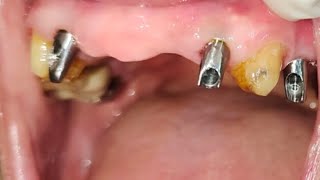 Case Presentation  Dental Implants for Replacement of Missing teeth in the Maxillary Arch [upl. by O'Malley]