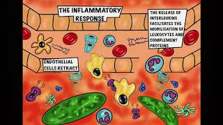 Appendicitis an Inflammatory Tale [upl. by Carolle]