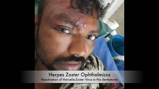 Herpes Zoster Ophthalmicus ONLY CASE [upl. by Gibb]