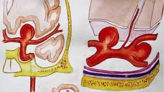 Understanding Brain aneurysm and endovascular coiling [upl. by Fortunio]