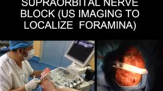 ULTRASOUND GUIDED SUPRAORBITAL NERVE BLOCK ULTRASOUND IMAGING TO LOCALIZE FORAMINA [upl. by Bej643]