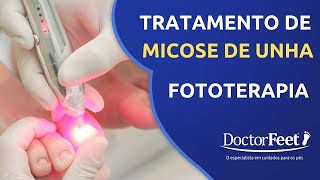 Tratamento de Micose de Unha com Laser  Fototerapia [upl. by Lenwood561]