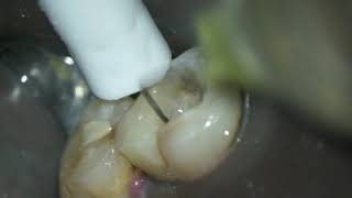 Caso clínico Dr Hipólito Fabra con limas de endodoncia Proclinic Expert [upl. by Alcock]