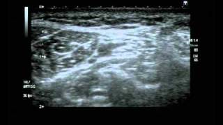 Posterior Tibial Nerve Block Ultrasound guided [upl. by Adniuqal]