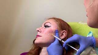 Acne Scar Treatment with Bellafill dermal filler in Seattle at Well Medical Arts [upl. by Hsac]