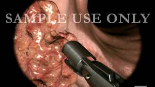 Colon Biopsy [upl. by Brod694]