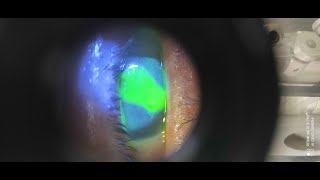 loss of vision after lime contact with eyes [upl. by Ahscrop]