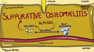 Suppurative Osteomyelitis of the jaw [upl. by Silecara]