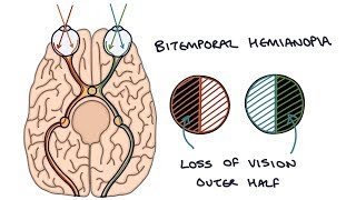 Understanding Bitemporal Hemianopia [upl. by Aralc]