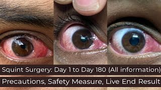 My Story  Before and After SquintStrabismus Surgery Day 1 to Day 180 [upl. by Senzer]