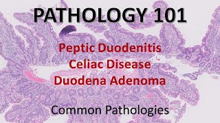 Peptic Duodenitis Celiac Disease Duodenal Adenoma  Pathology 101 GI Pathology [upl. by Ggerk177]