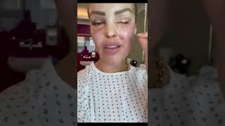 Katie Piper updates after surgery to reduce risk of losing left eye [upl. by Redmund]