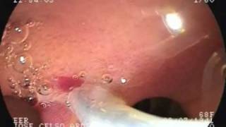 Duodenal carcinoid tumor  endoscopic resection after EUS [upl. by Ahseikram117]