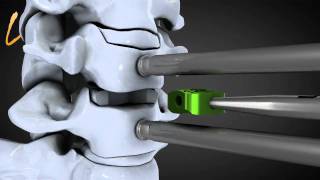 Hernie discale cervicale  Spinal disk herniation  Kisco International [upl. by Fagaly]