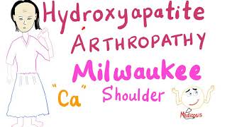 Hydroxyapatite Arthropathy  Milwaukee Soulder [upl. by Cr]