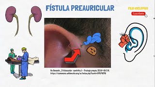 FÍSTULA PREAURICULAR [upl. by Gassman967]