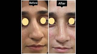 Crooked Nose Endonasal Rhinoplasty [upl. by Nniw]