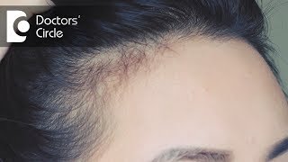 How to get rid of severe PCOS causing Hairfall  Dr Shefali Tyagi [upl. by Yelrehs]