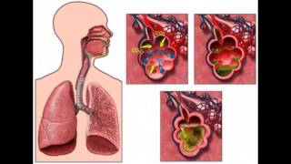 BRONQUITIS CAUSAS SÍNTOMAS Y TRATAMIENTO BRONQUIOLITIS TRATAMIENTO PARA BRONQUITIS NEBULIZACIÓN [upl. by Lleda]