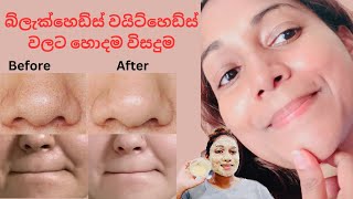 How to remove Blackheads whiteheadshome remedy for blackheads whiteheads removal sinhala [upl. by Ahseei]