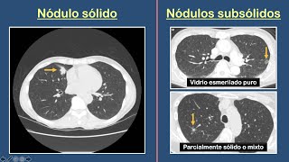 Nódulo Pulmonar Solitario [upl. by Esened818]