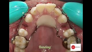 orthodontic treatment with only upper 1st premolar extraction upper 4 4 extracted [upl. by Anilem]