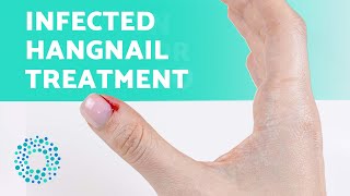 HOW to TREAT an INFECTED HANGNAIL 😟 Get Rid of Hangnails Easily [upl. by Adyahs]