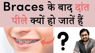 Yellow Teeth after Braces  Braces के बाद दांत पीले क्यों हो जातें हैं  Side effect of Braces [upl. by Aihsat]