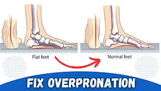 How to Correct Overpronation Fallen Arches [upl. by Mosi]