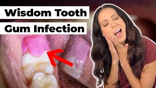 what does this SWOLLEN gum flap mean Pericoronitis Explained [upl. by Hyacinthia]