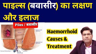 What Are Piles HEMORRHOIDS Causes Symptoms and Treatment  in Hindi [upl. by Damali]