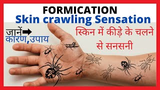 FormicationSkin crawling sensationReason amp Home remedyस्किन में कीड़े चलने जैसी सनसनीघरेलू उपाय [upl. by Salvidor]