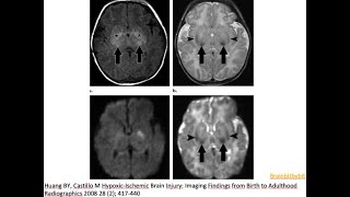 12 Neonatal asphyxia and diffusion weighted MRI DWI  hypoxic ischemic encephalopathy HIE b1000 [upl. by Larrabee754]