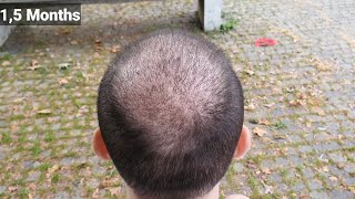 FUE Hair Transplant Timeline I Day 1 to Day 365 I Before amp After [upl. by Rosene317]