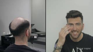 Antes y después de una prótesis capilar indetectable  Hair Inspira [upl. by Anilef187]